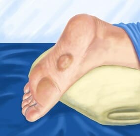 orthotics for plantar fibroma 2