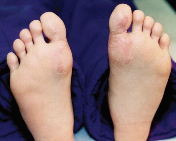 cream for juvenile plantar dermatosis 2