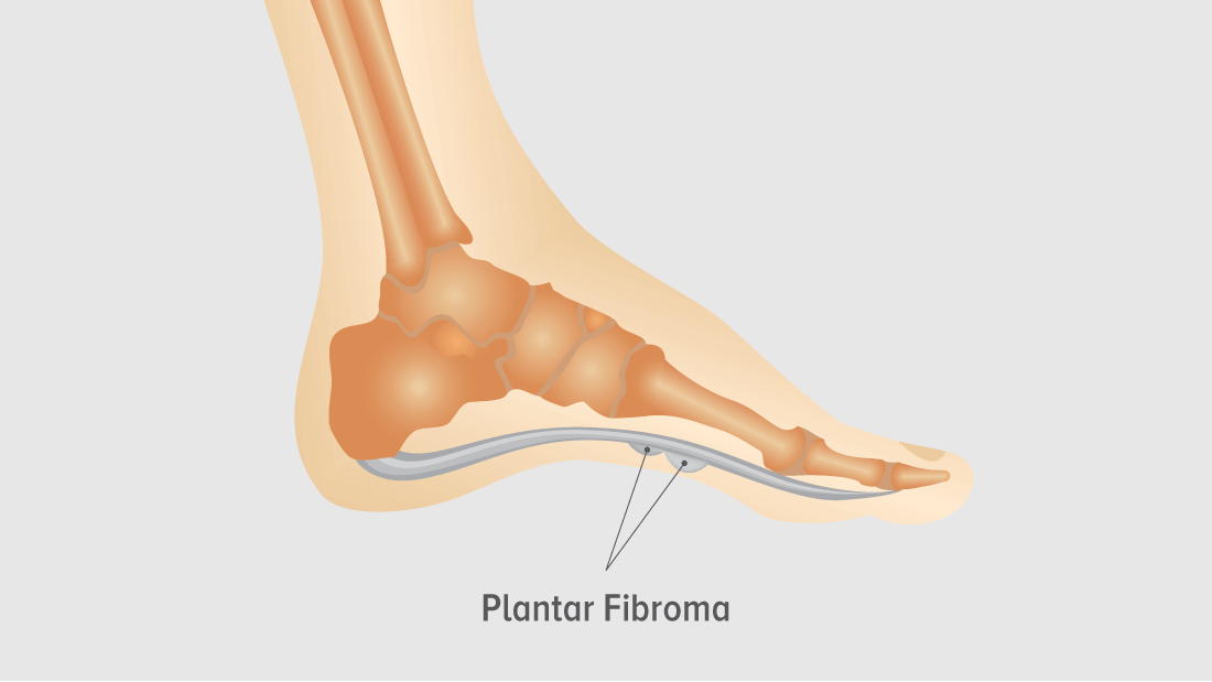 orthotics for plantar fibroma 1